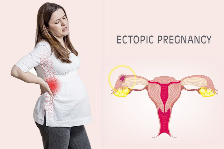ectopic pregnancy